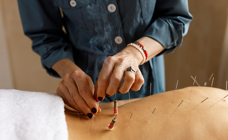 Patient receiving acupuncture as part of the addiction therapy and treatment